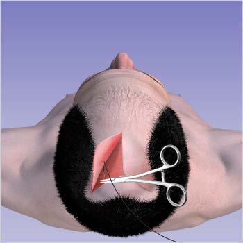 tratamente chirurgicale reductie scalp