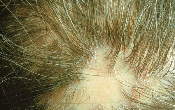 Alopeciile cicatriciale
