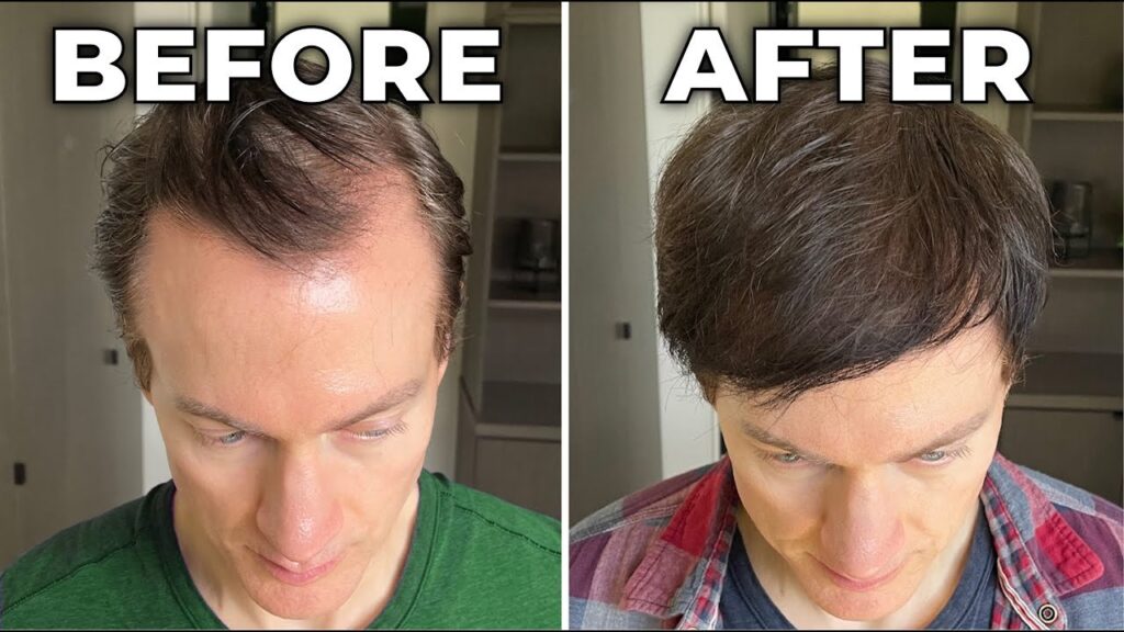 Rezultatele tratamentului de regenerare a părului – comparație înainte și după un an de tratament FUE și minoxidil.